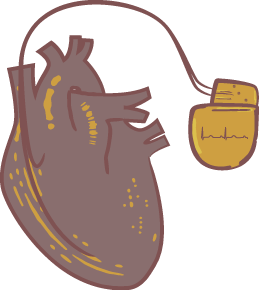 A pacemaker.